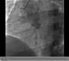 Coronary Angiogram 1 - Demonstrating narrowed right artery.
